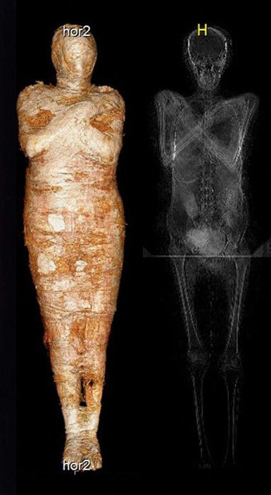 Röntgenfelvétel a múmiáról – Kép: Warsaw Mummy Project / AFP