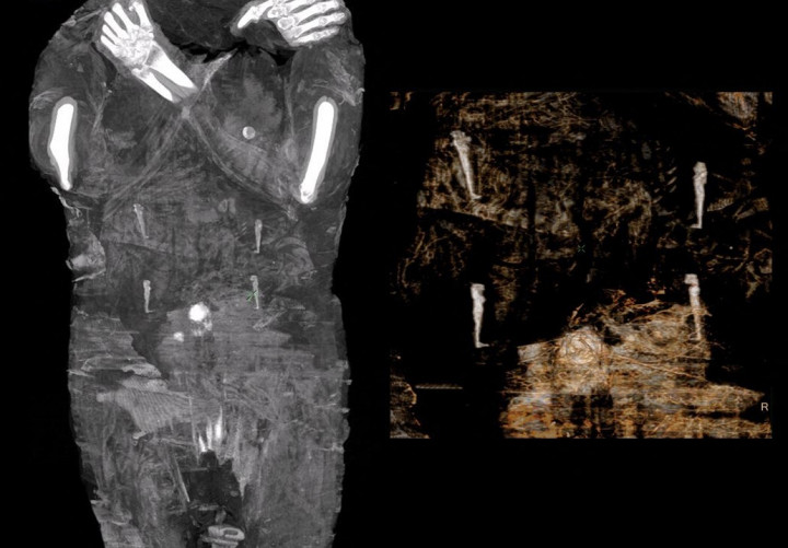 Röntgenfelvétel a nő hasi részéről. Látható négy amulett és egy tárgy a köldökön – Kép: Warsaw Mummy Project / AFP