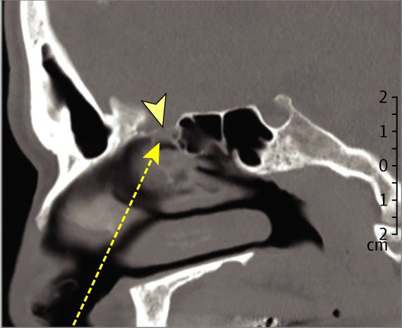 Valahogy így történt (CT felvétel a tanulmányból) – Kép: JAMA Otolaryngol Head Neck Surg